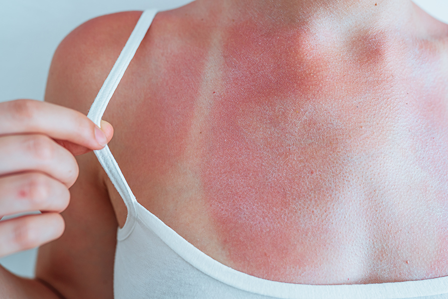 woman's check and shoulder showing a bad sun burn