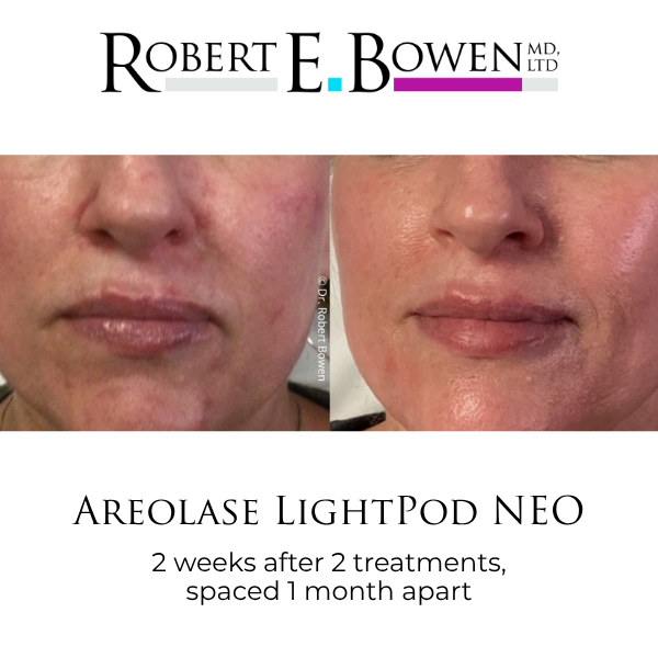 Areolase LightPod NEO Before & After