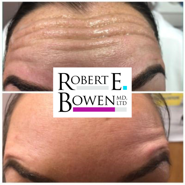 Tox Injections Before & After Photos