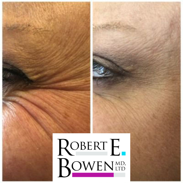 Tox Injections Before & After Photos