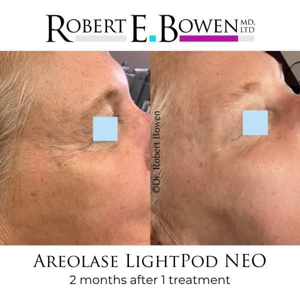 Areolase LightPod NEO Before & After