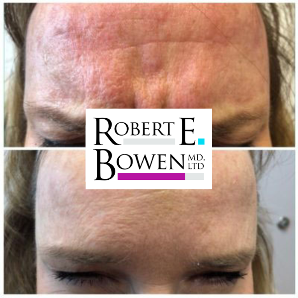 Tox Injections Before & After Photos