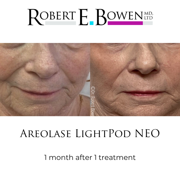 Areolase LightPod NEO Before & After