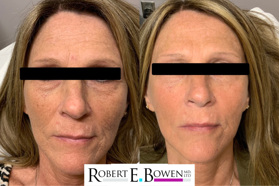 BBL HERO Before & After