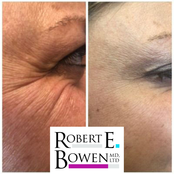 Tox Injections Before & After Photos