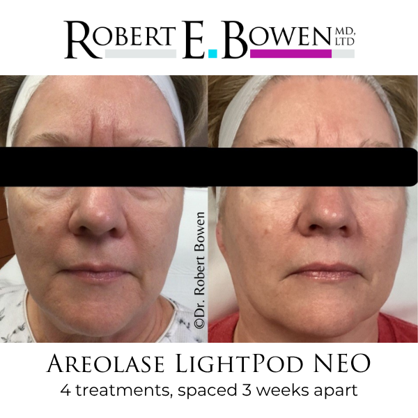 Areolase LightPod NEO Before & After