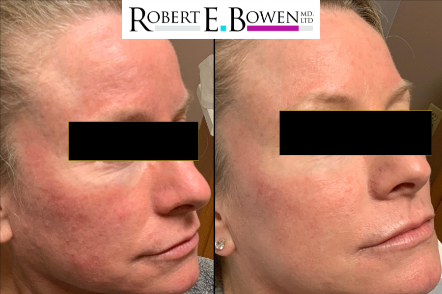 BBL HERO Before & After