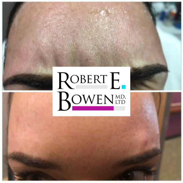 Tox Injections Before & After Photos