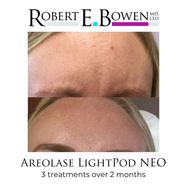Areolase LightPod NEO Before & After