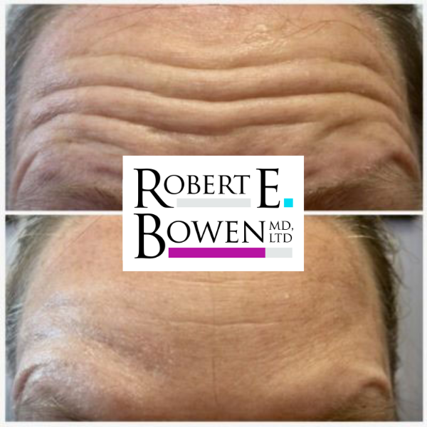Tox Injections Before & After Photos