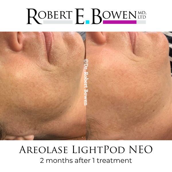 Areolase LightPod NEO Before & After