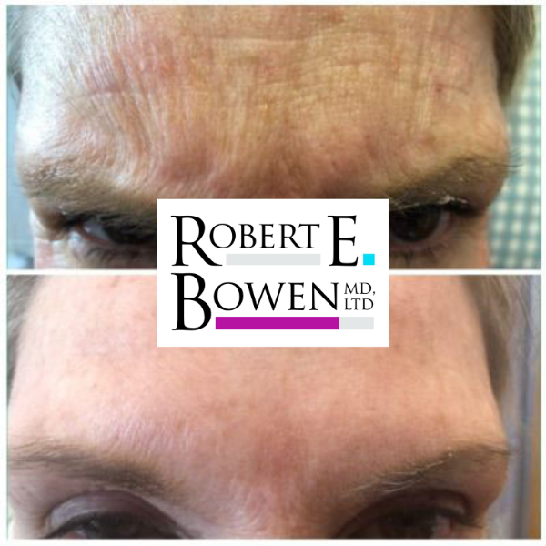 Tox Injections Before & After Photos