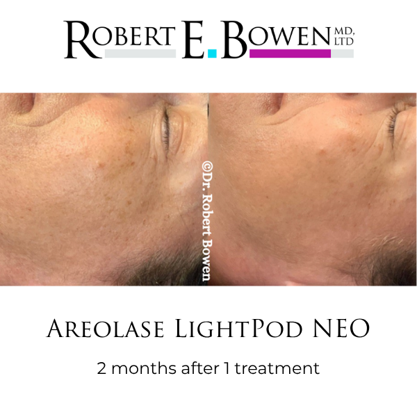 Areolase LightPod NEO Before & After