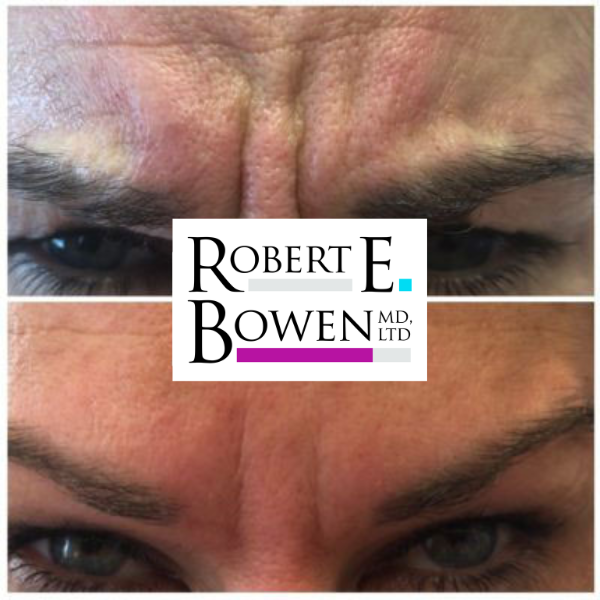 Tox Injections Before & After Photos