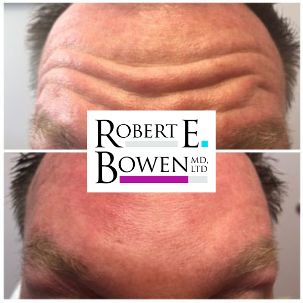 Tox Injections Before & After Photos