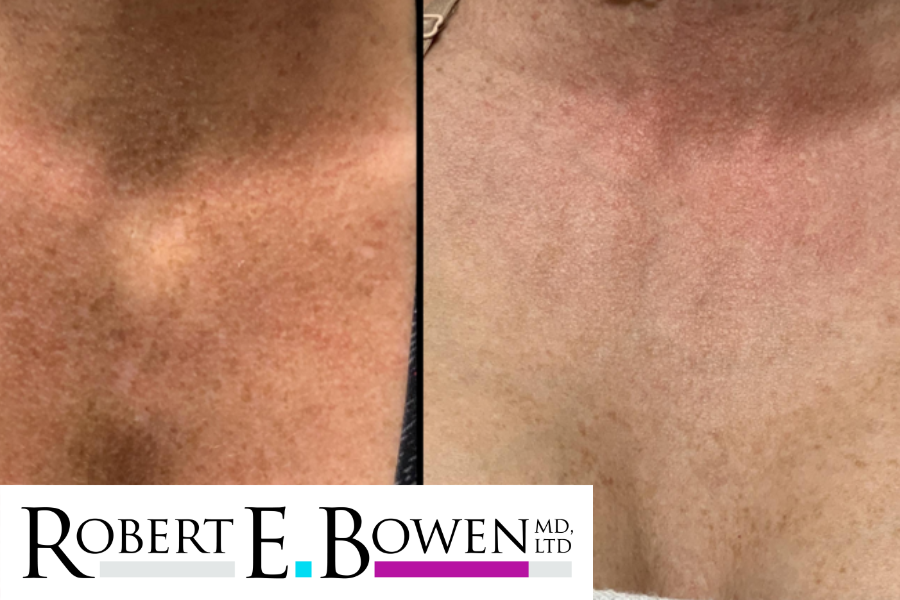 BBL HERO Before & After