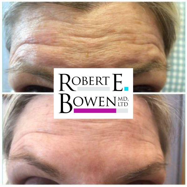Tox Injections Before & After Photos