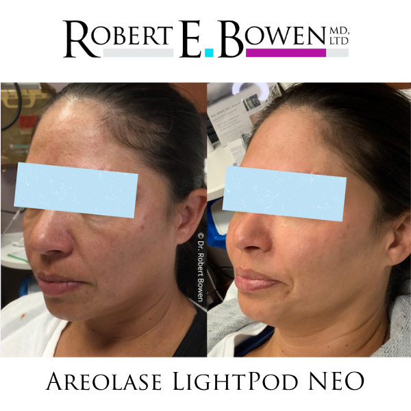 Areolase LightPod NEO Before & After