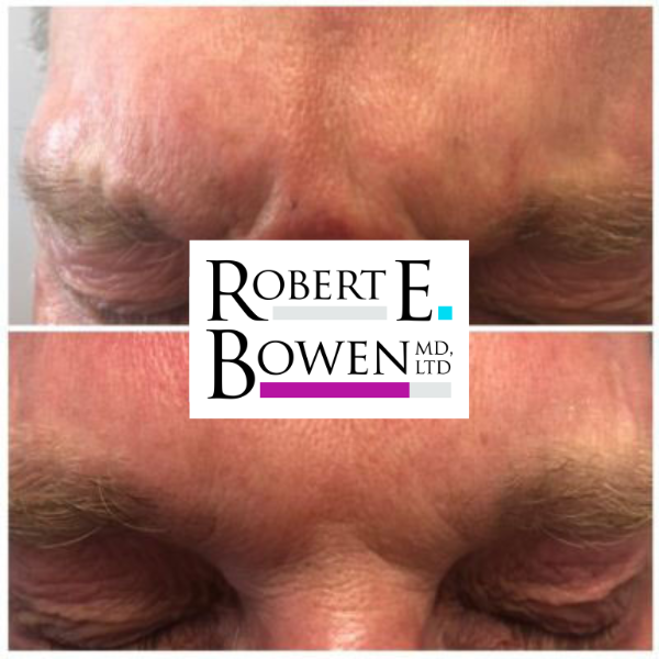 Tox Injections Before & After Photos