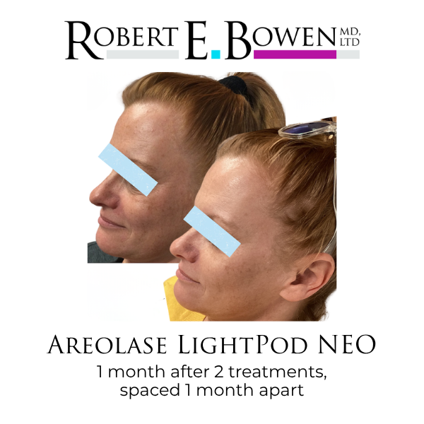 Areolase LightPod NEO Before & After