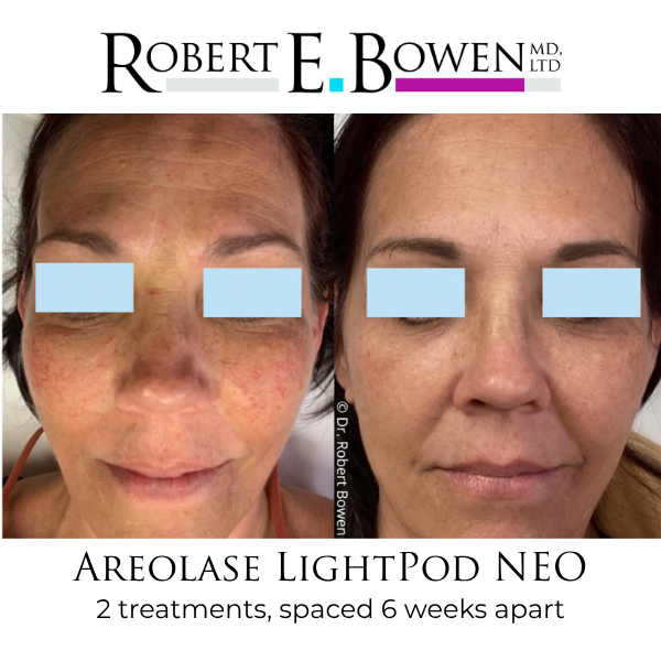 Areolase LightPod NEO Before & After