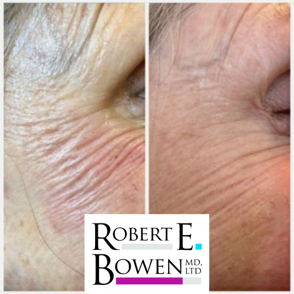 Tox Injections Before & After Photos
