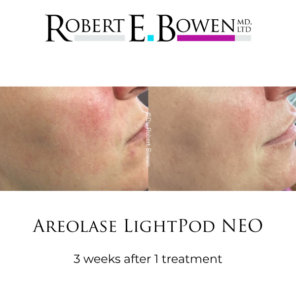 Areolase LightPod NEO Before & After