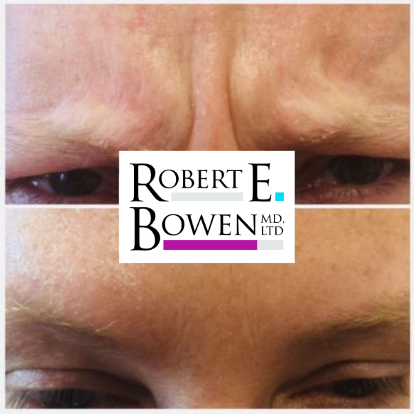 Tox Injections Before & After Photos