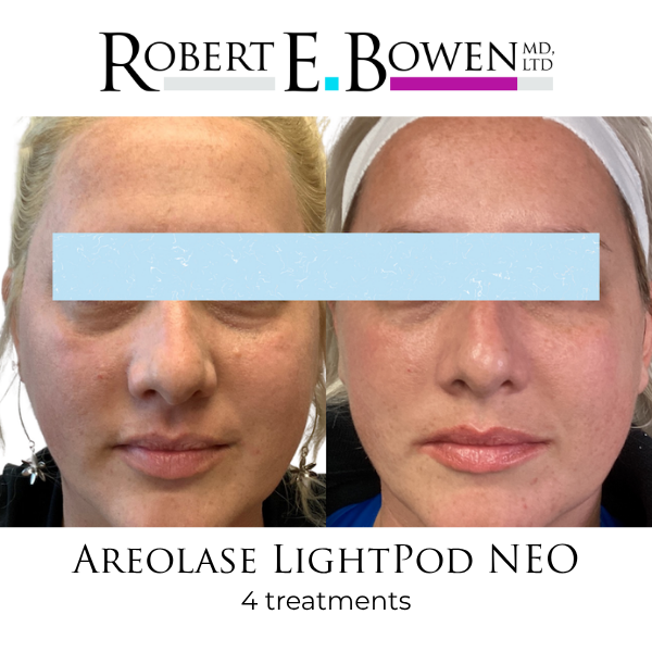 Areolase LightPod NEO Before & After