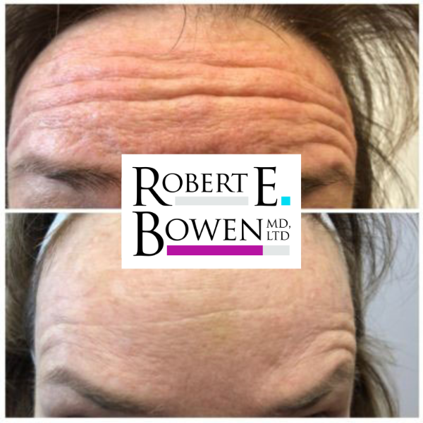 Tox Injections Before & After Photos
