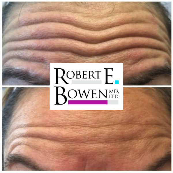 Tox Injections Before & After Photos