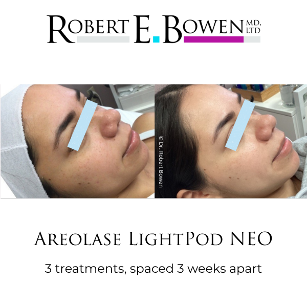 Areolase LightPod NEO Before & After