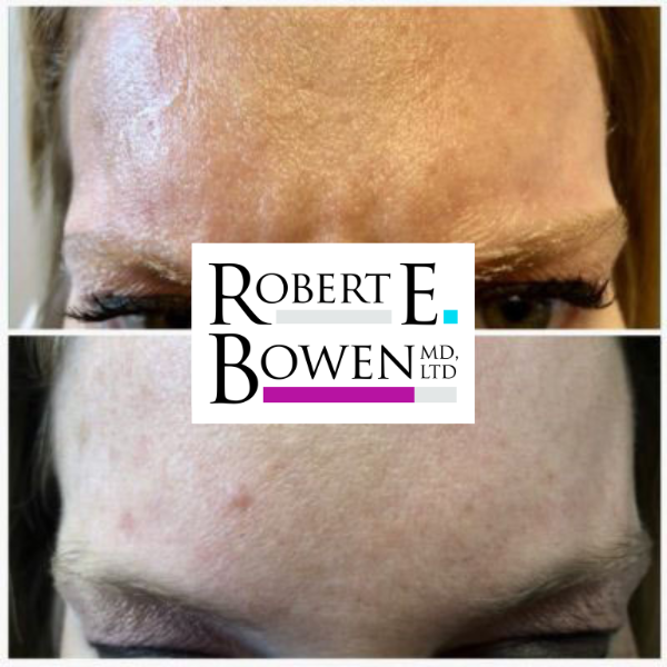 Tox Injections Before & After Photos