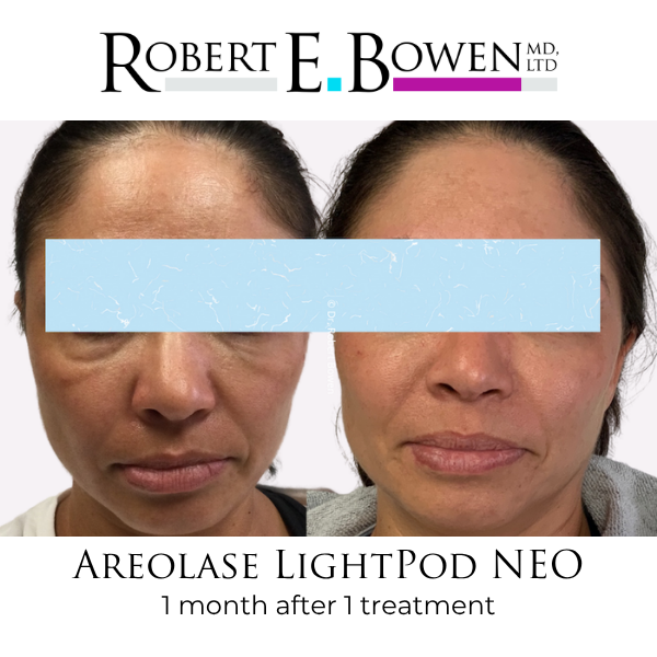 Areolase LightPod NEO Before & After