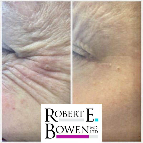 Tox Injections Before & After Photos