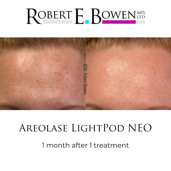 Areolase LightPod NEO Before & After