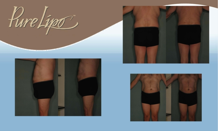 DRB - PureLipo Before & Afters
