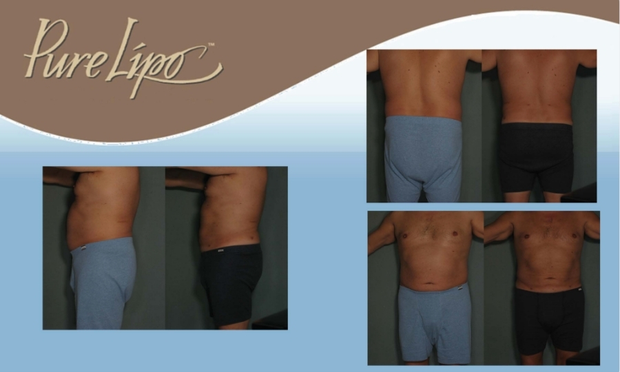 DRB - PureLipo Before & Afters