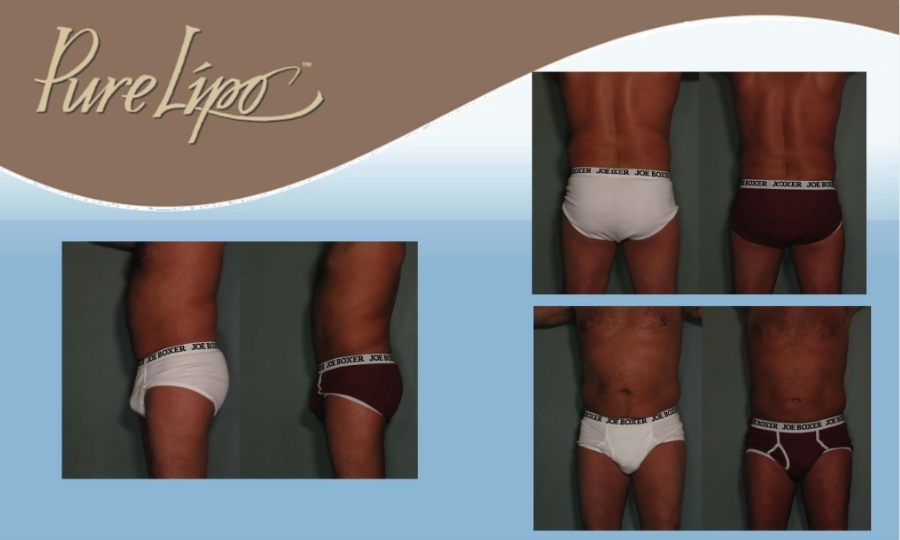 DRB - PureLipo Before & Afters