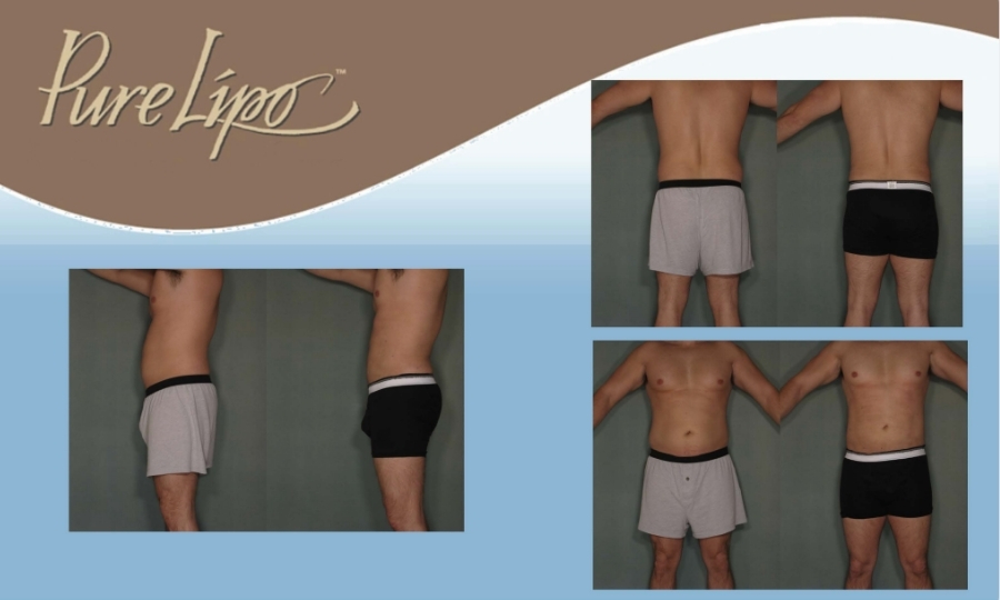 DRB - PureLipo Before & Afters