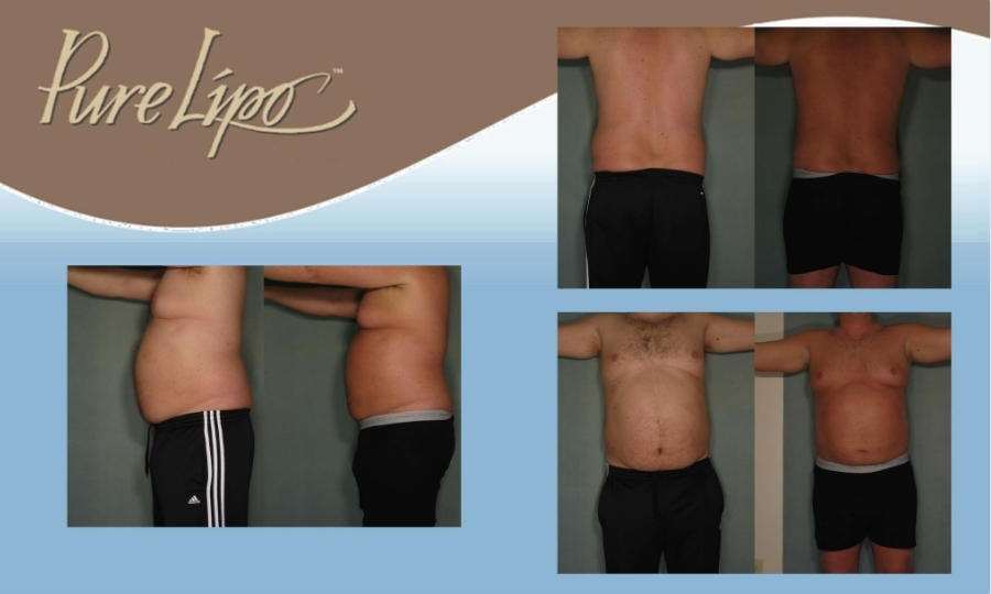 DRB - PureLipo Before & Afters