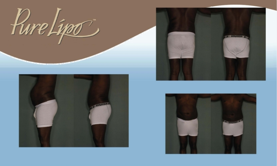 DRB - PureLipo Before & Afters