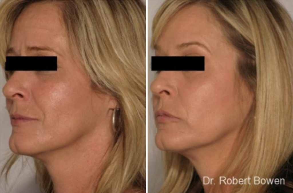 Dermal Filler Before and After