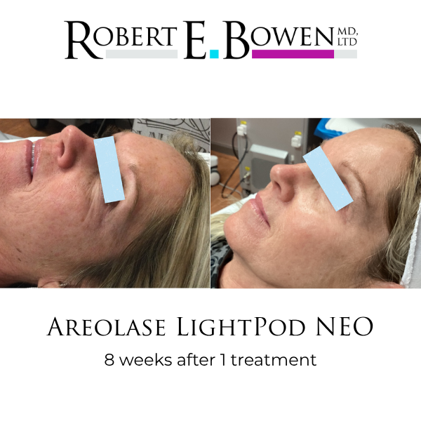 Areolase LightPod NEO Before & After
