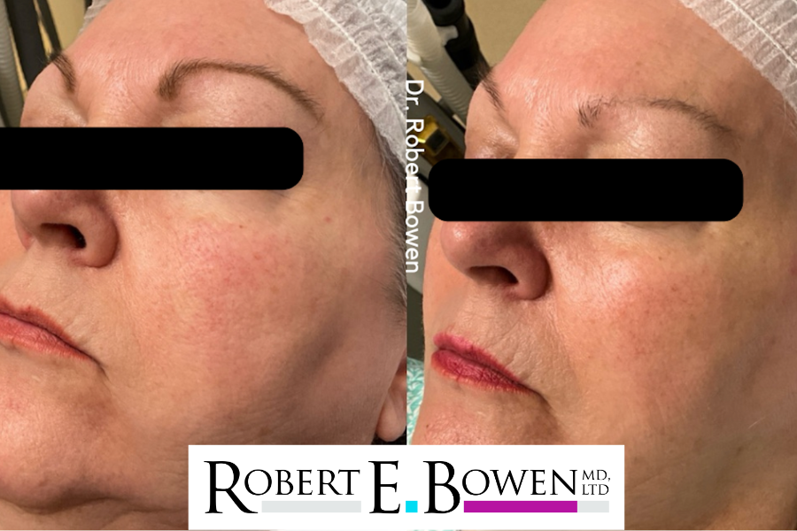 Dr. Bowen -BBL Before & After Photos