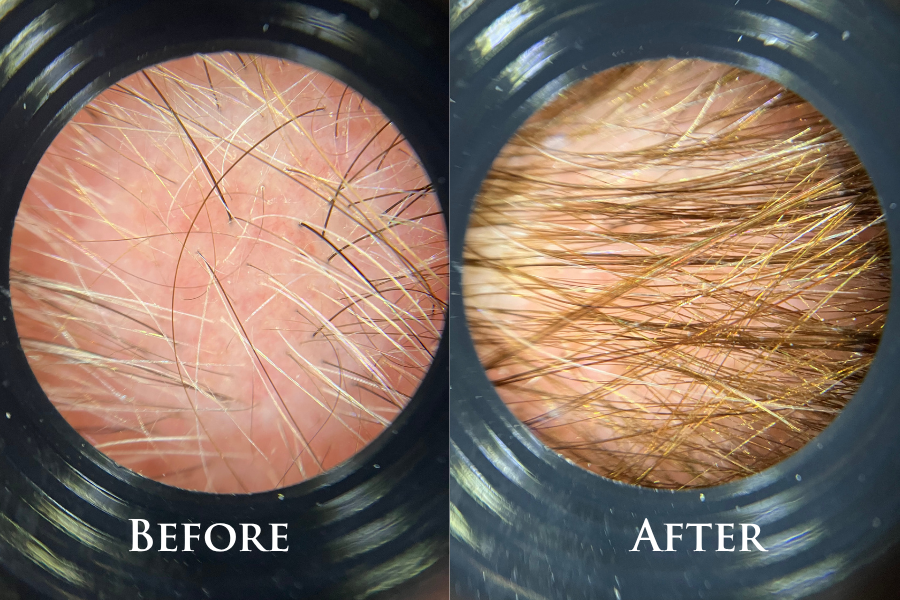 Hair Restoration Before & After
