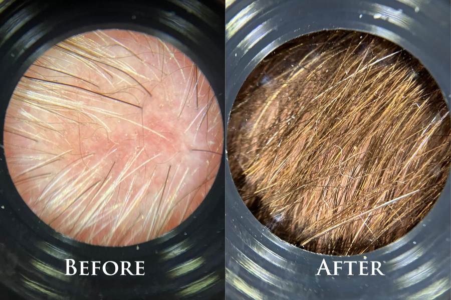 Hair Restoration Before & After (2)