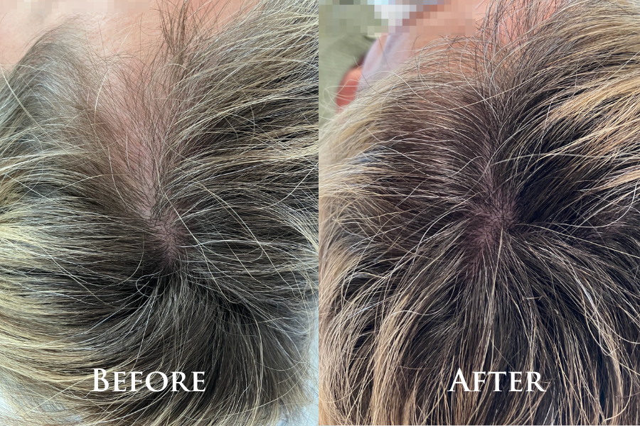 Hair Restoration Before & After