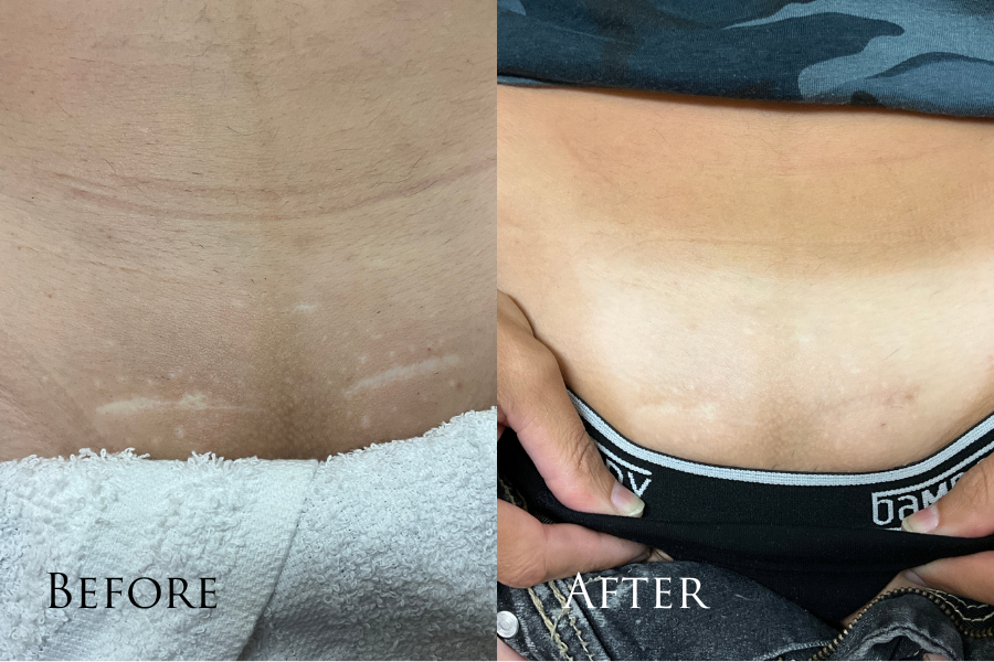 ProFractional Before & After