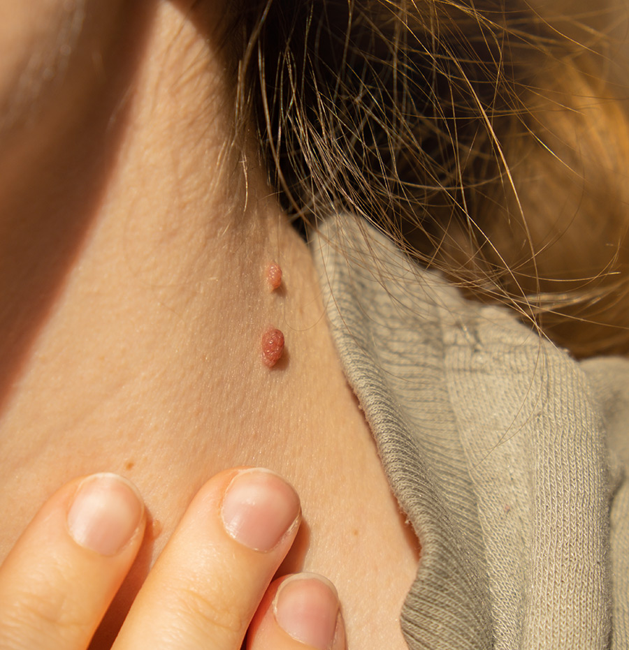 skin tags on woman neck